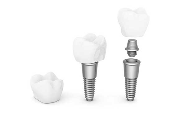 Dental implant components used to support replacement teeth